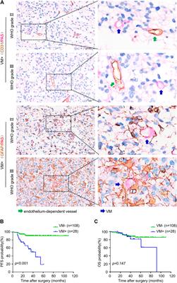 Vasculogenic Mimicry Formation Predicts Tumor Progression in Oligodendroglioma